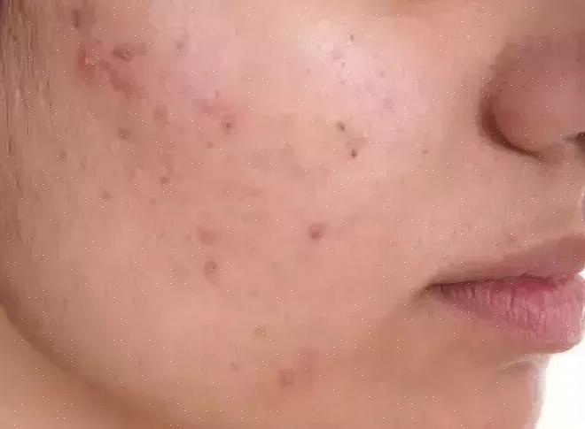 Aqui estão as etapas sobre como você pode fazer desaparecer as cicatrizes de acne