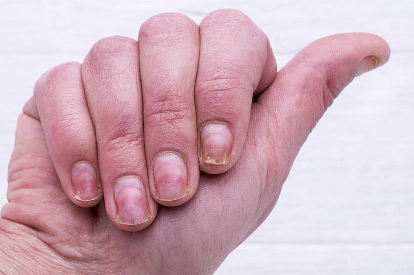 Especialmente se houver mais de uma causa para a descamação das unhas